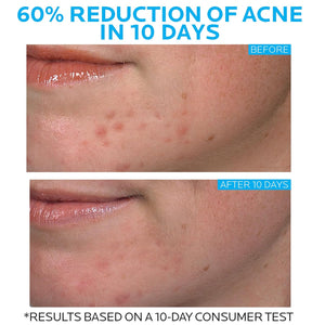 Effaclar Duo Dual Action Acne Spot Solution Cream with Benzoyl Peroxide  By La Roche-Posay 40ML